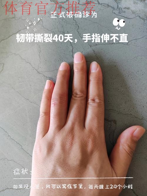 Siegel:康查尔左手拇指尺侧副韧带撕裂,三周后复查 Siegel:康查尔左手拇指尺侧副韧带撕裂,三周后复查